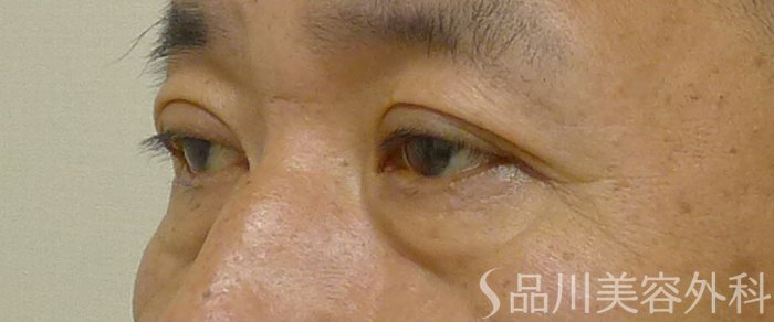 症例NO.72159のAFTER写真