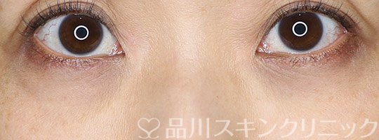 症例NO.74010のAFTER写真