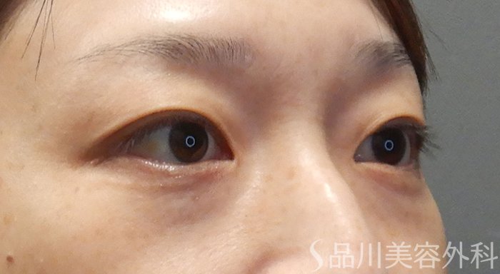 症例NO.72003のBEFORE写真