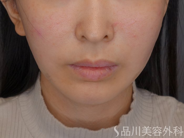 症例NO.72688のAFTER写真