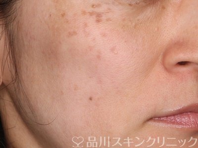 症例NO.75214のBEFORE写真