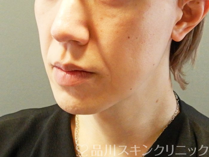 症例NO.63154のBEFORE写真