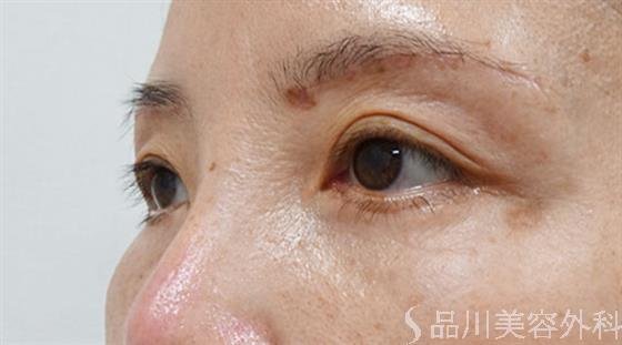 症例NO.50761のAFTER写真
