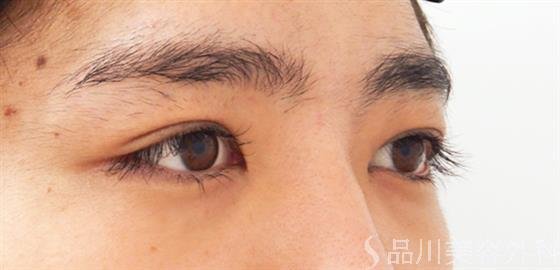 症例NO.53859のAFTER写真