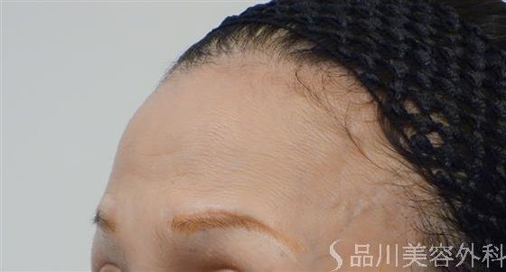 症例NO.51172のBEFORE写真