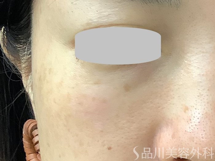 症例NO.67846のBEFORE写真