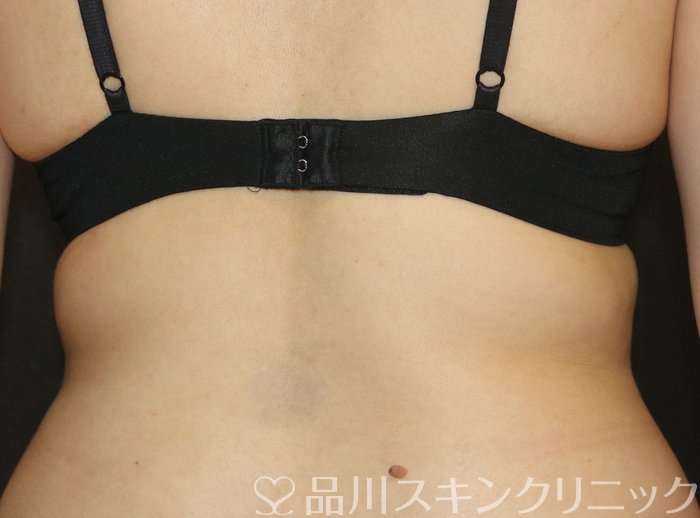 症例NO.72634のBEFORE写真