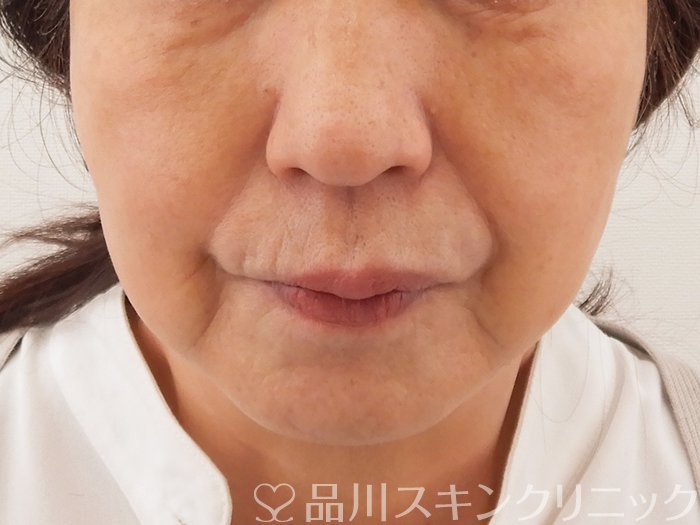 症例NO.62187のAFTER写真