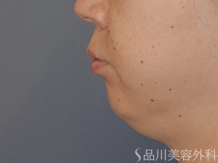 症例NO.71006のBEFORE写真