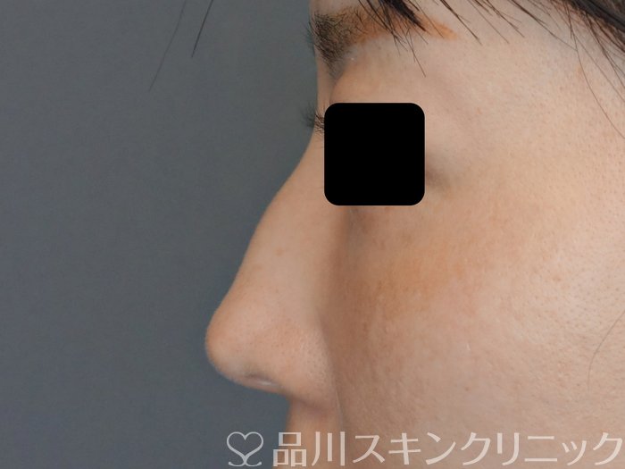 症例NO.71874のBEFORE写真