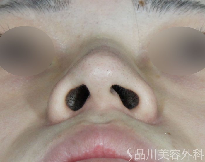 症例NO.71295のBEFORE写真