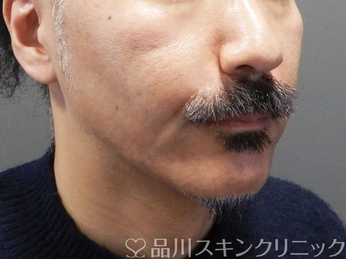 症例NO.72411のAFTER写真