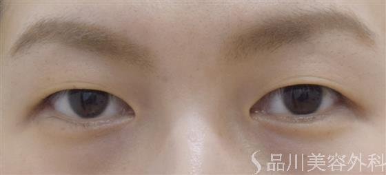 症例NO.52538のBEFORE写真