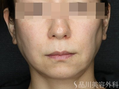 症例NO.69652のBEFORE写真