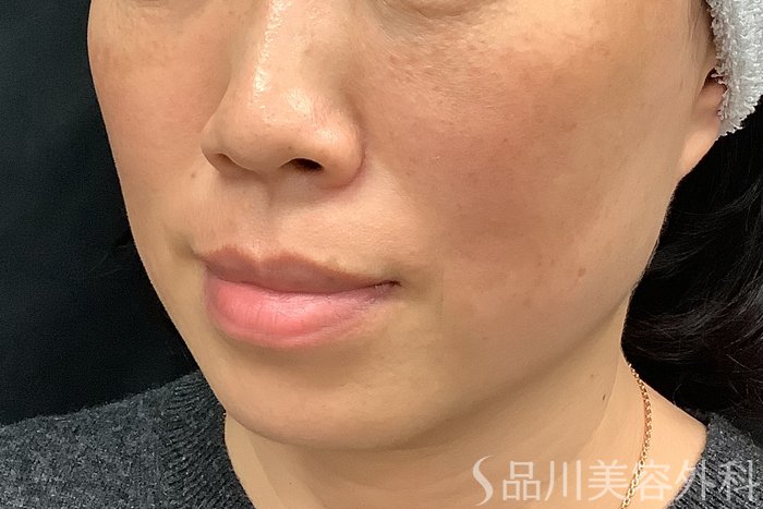 症例NO.73314のBEFORE写真