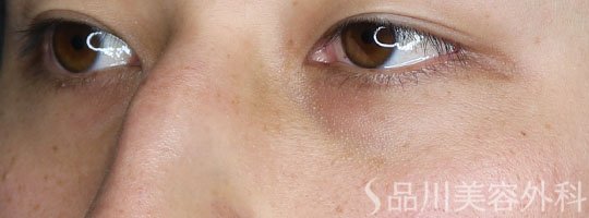 症例NO.72639のBEFORE写真