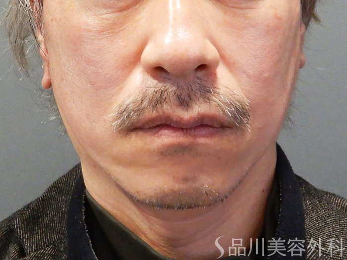 症例NO.70137のAFTER写真