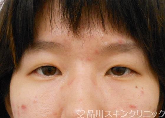 症例NO.53908のBEFORE写真