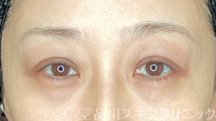 症例NO.62853のAFTER写真