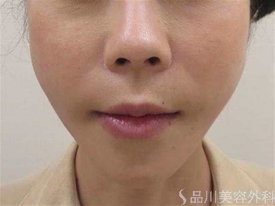 症例NO.35591のAFTER写真