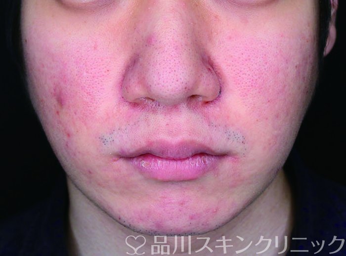 症例NO.69759のBEFORE写真