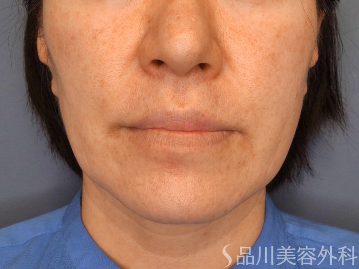 症例NO.65537のBEFORE写真