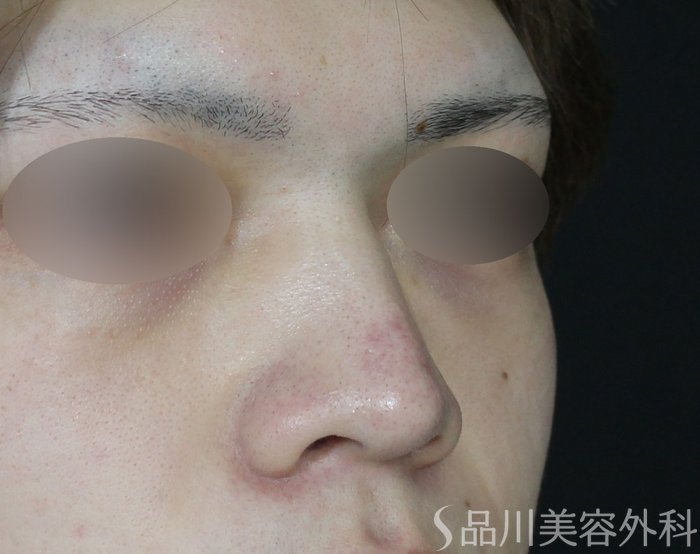 症例NO.71295のBEFORE写真