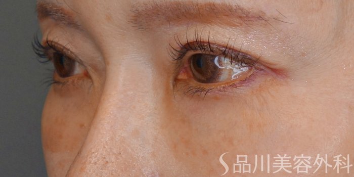 症例NO.73362のBEFORE写真