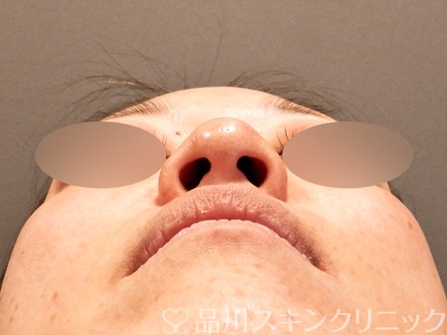 症例NO.69576のBEFORE写真