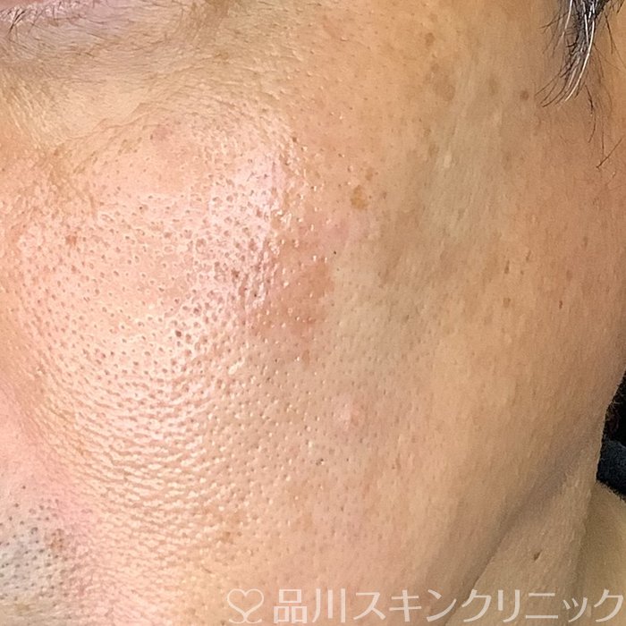 症例NO.72978のAFTER写真