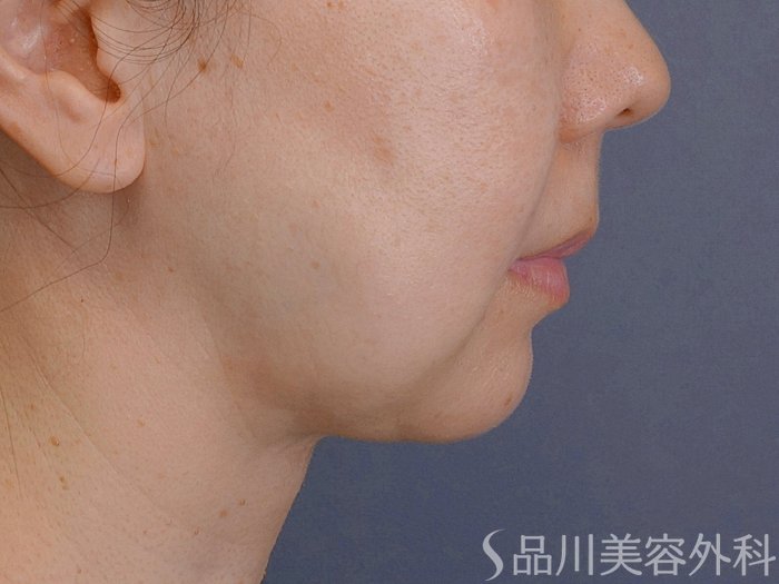 症例NO.74657のBEFORE写真