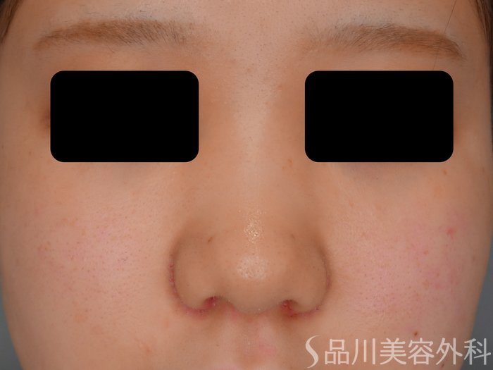 症例NO.74871のAFTER写真