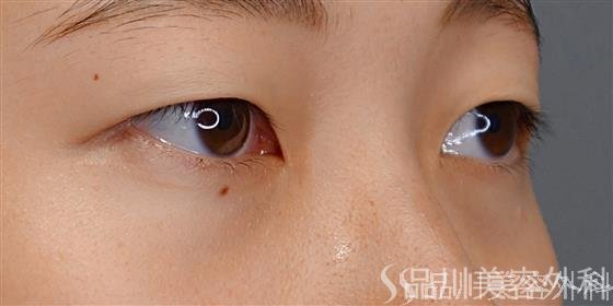 症例NO.72321のBEFORE写真