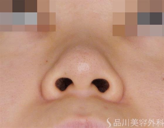 症例NO.49499のBEFORE写真