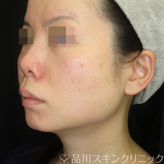 症例NO.74617のBEFORE写真