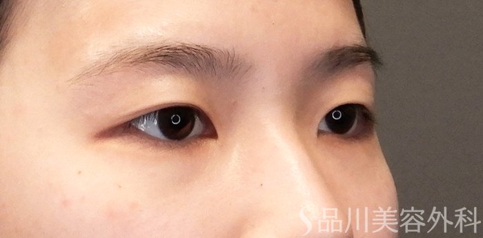 症例NO.65026のBEFORE写真