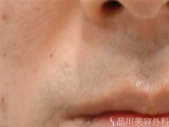 症例NO.40753のAFTER写真