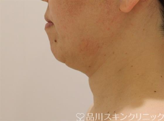 症例NO.47509のBEFORE写真