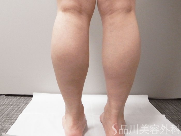 症例NO.71627のBEFORE写真