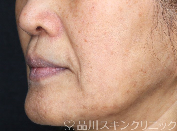 症例NO.69481のBEFORE写真