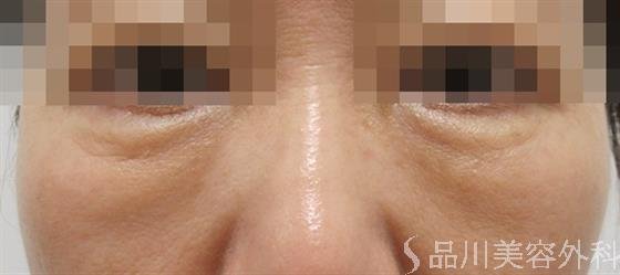 症例NO.46317のBEFORE写真