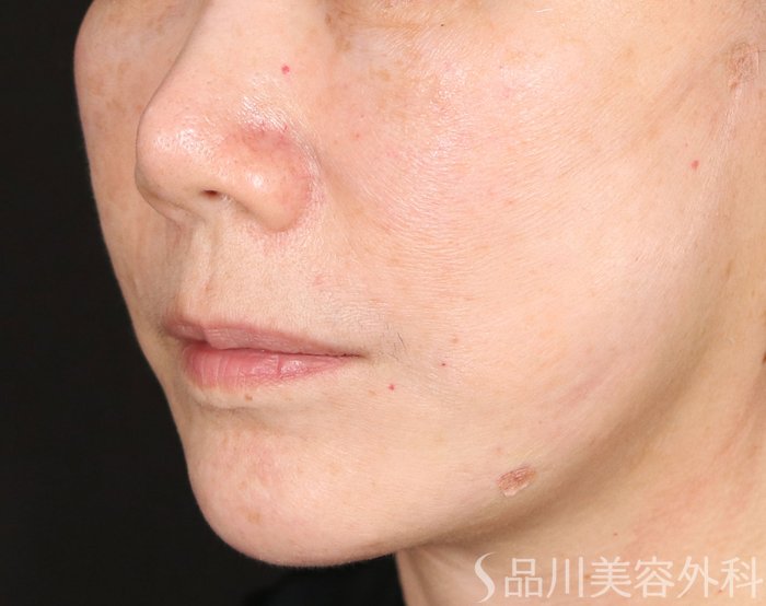 症例NO.71022のAFTER写真