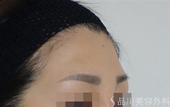 症例NO.49464のBEFORE写真