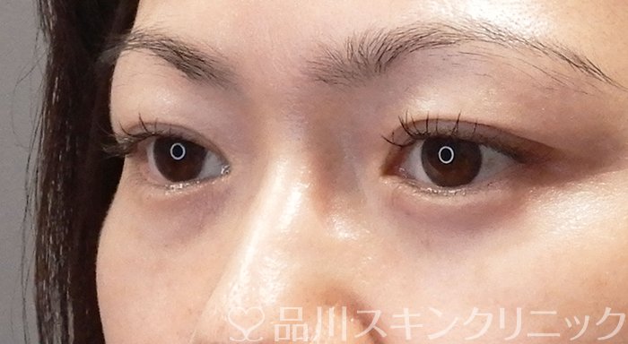 症例NO.69558のAFTER写真