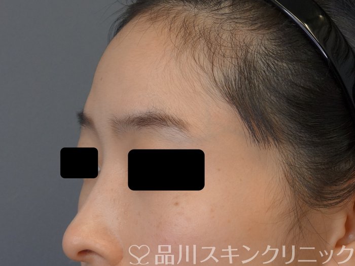 症例NO.74090のBEFORE写真