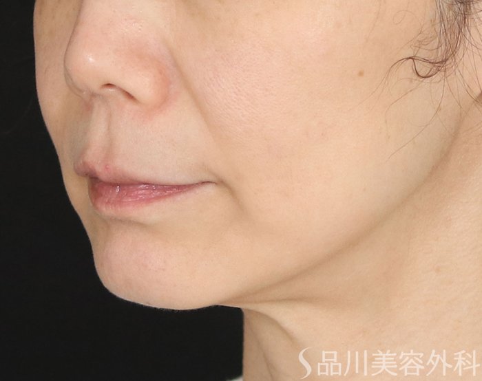 症例NO.73681のBEFORE写真