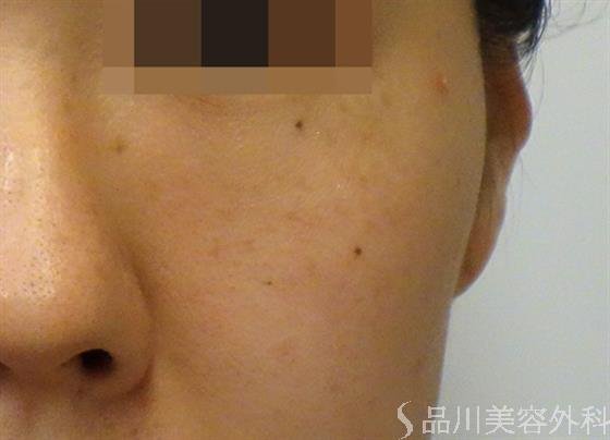 症例NO.47416のBEFORE写真
