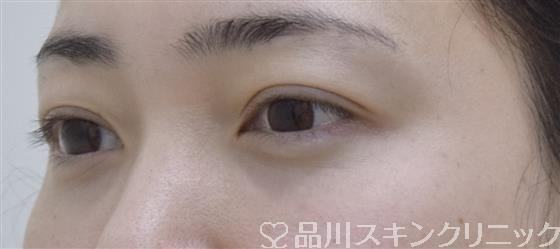 症例NO.52948のAFTER写真