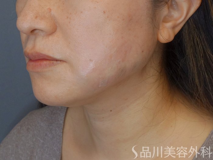 症例NO.72053のAFTER写真