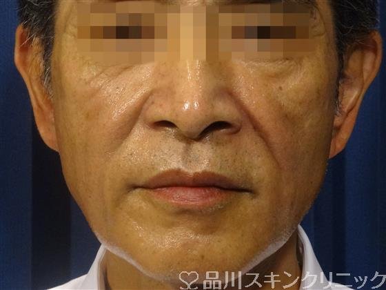 症例NO.32760のAFTER写真